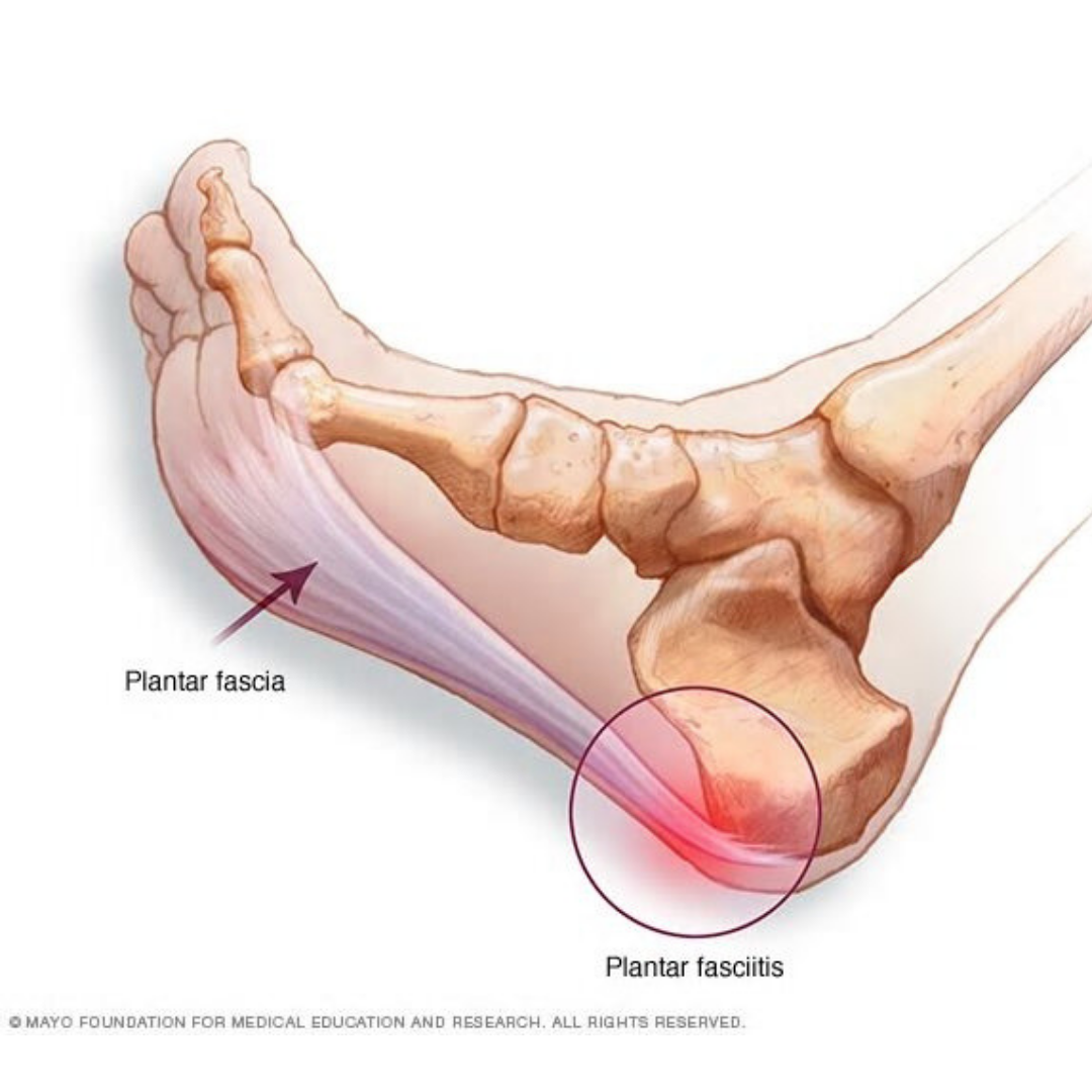 running foot arch pain