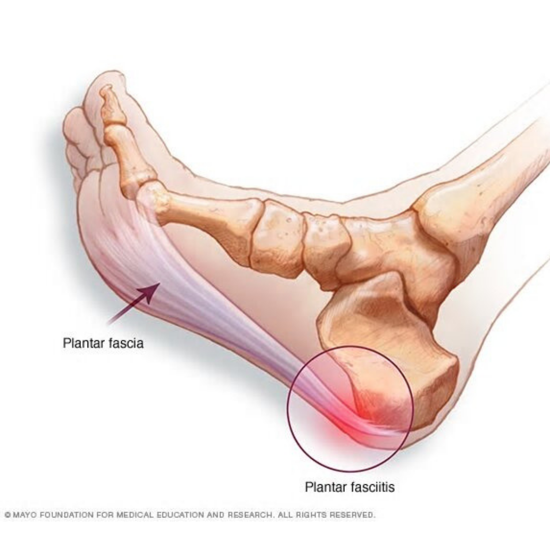 runners heel pain