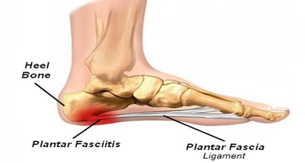 pain on inside of heel after running