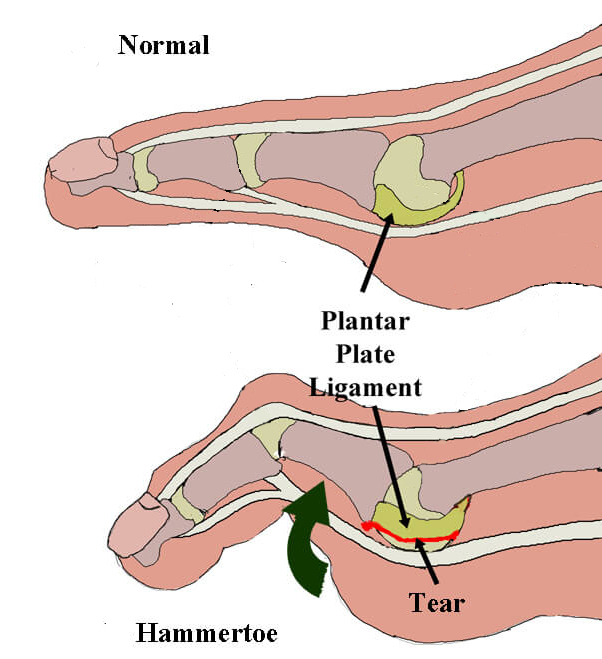 plantar pad